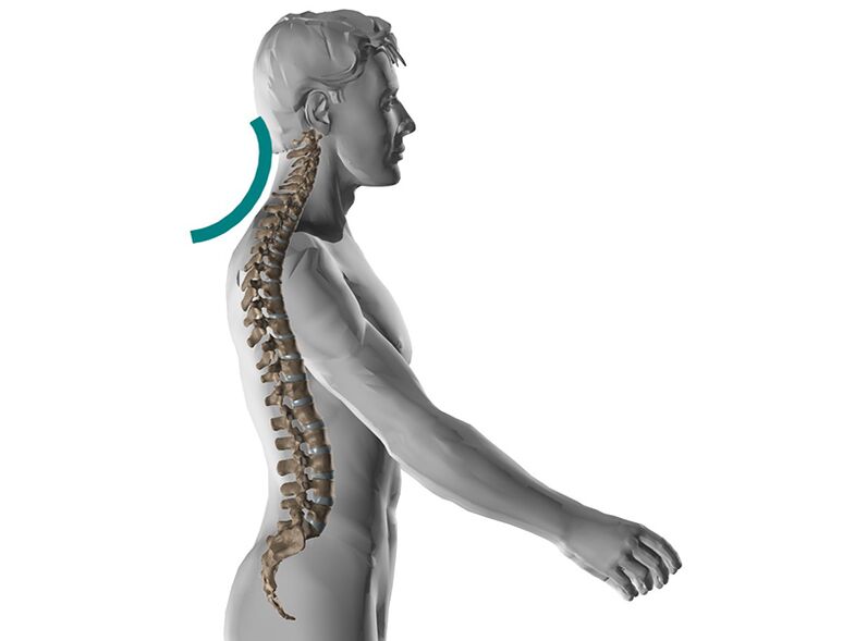 Osteocondrosi cervicale della colonna vertebrale, causando molti sintomi spiacevoli