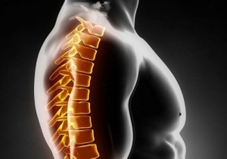 L'osteocondrosi toracica accompagna dolore e disagio nella parte centrale della schiena