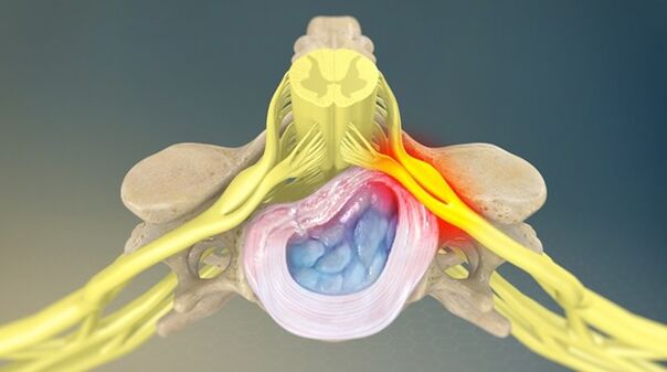 sindrome radicolare come causa di lombalgia