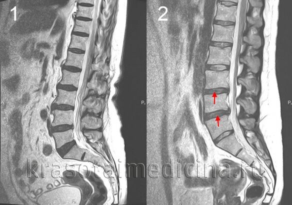 osteocondrosi spinale